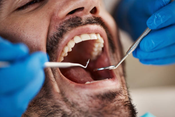 Best Emergency Wisdom Tooth Extraction in Cambridge, IL